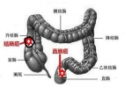 身體出現(xiàn)哪些信號提示直腸癌呢？